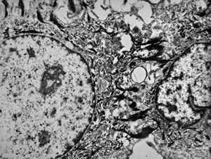 F,31y. | mucoepidermoid carcinoma F,31y. | mucoepidermoid carcinoma